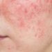 Rosacea Warriors: Creams That Tackle Redness Head-On