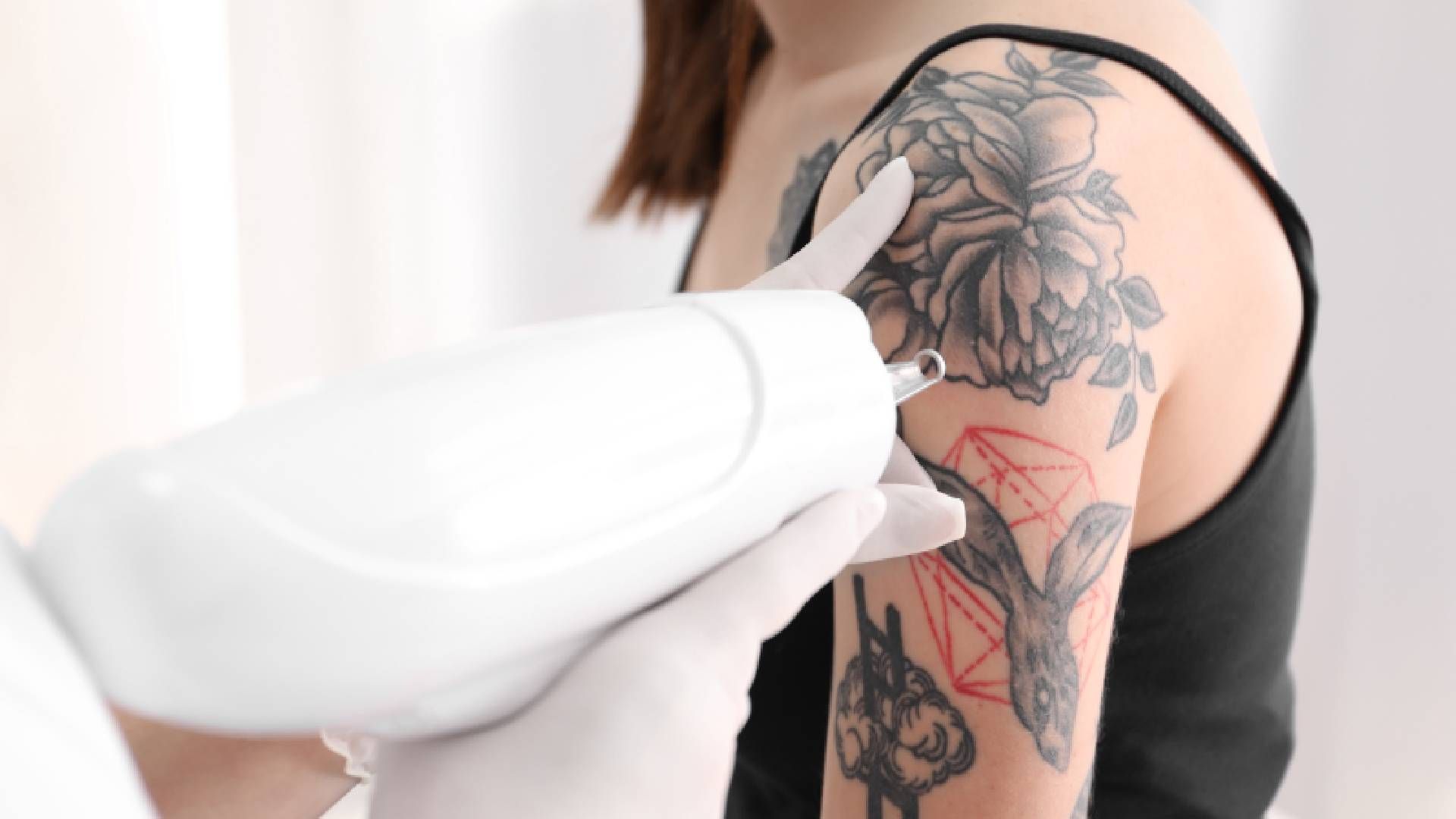 Fading Ink: Understanding the Process and Options for Tattoo Removal
