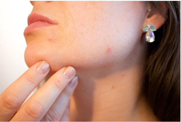 What Treatments Are Effective for Acne Scars?