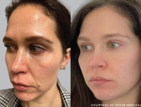 How Cellenis Derma PRP Can Help Reduce Fine Lines and Wrinkles