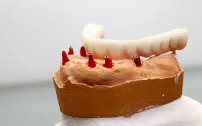London’s Guide to Life-Changing Tooth Replacement