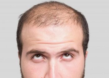 Is There a Cure for Permanent Baldness?
