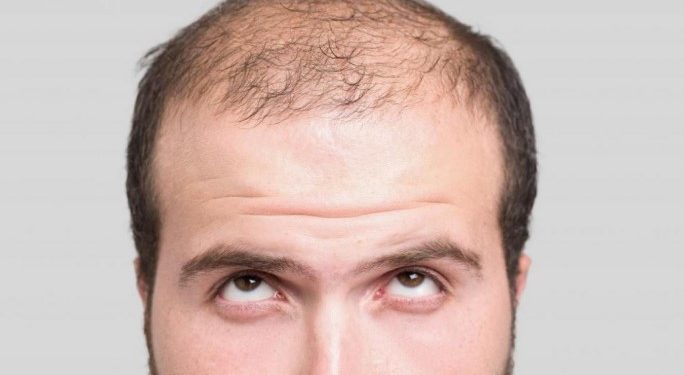 Is There a Cure for Permanent Baldness?