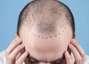 Hair System vs. Hair Transplant: Which One Is Right for You?