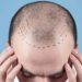 Hair System vs. Hair Transplant: Which One Is Right for You?